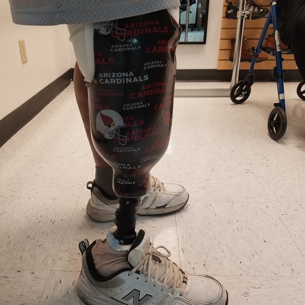 Prosthetic leg with an Arizona Cardinals sports team theme
